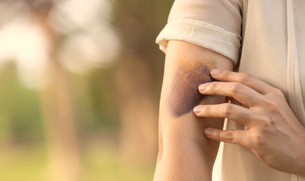Nodoznipolyarteritis.jpg